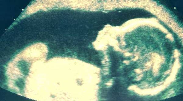 Лекарите во телото на жена пронашле фетус стар 40 години!