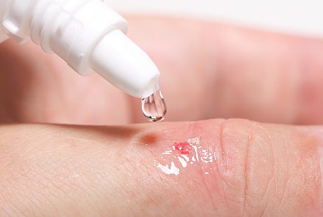 Еве зошто не треба да се испираат раните со алкохол